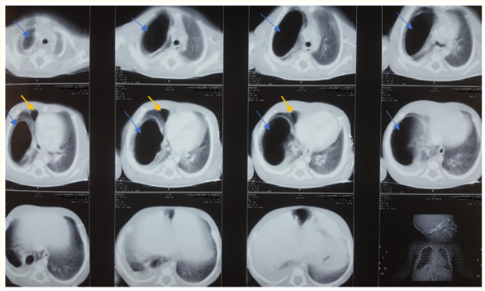 Image 2: CECT: Large right upper cyst (Blue arrows).
Small right middle cyst (yellow arrows).