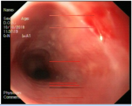 Figure 1: Web of esophagus in endoscopy.