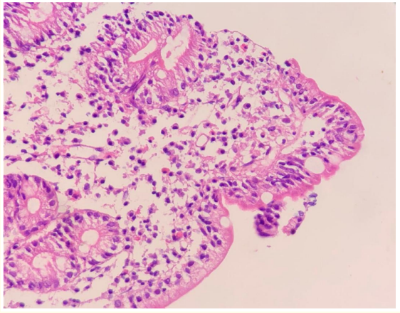 Figure 3: H and E stain- (duodenal biopsy). 