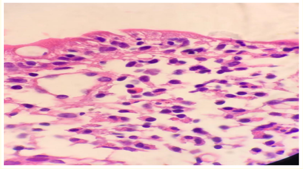 Figure 4: H and E stain- (duodenal biopsy). 