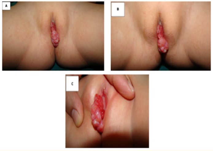 Figure 1A-C: A large, grapelike mass filling the vaginal vault. The urethra cannot be seen or distinguished from the mass.