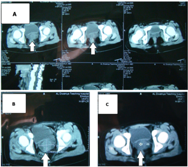 Figure 2A-C: Pelvic computerized tomographic scan (CT) with contrast revealed a solid, cystic mass 5x6.5x6 cm, located
anterior to the rectum, and at the posterior-superior aspect of the bladder (arrowed).
