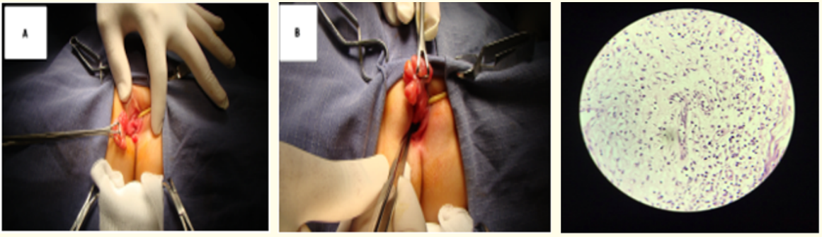 Figure 3A-B: Perioperative images where an en-bloc dissection of the total mass was done through a vaginal approach. The
tumor was arising from the superior part of the vagina.
