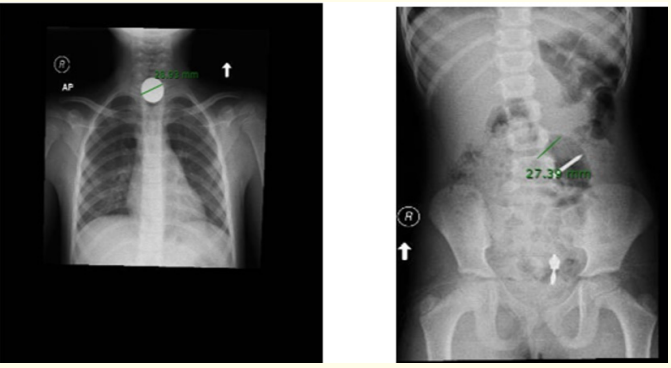Figure 5: Showing an impacted coin and a sharp.  