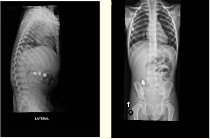 Figure 6: Showing multiple foreign bodies.