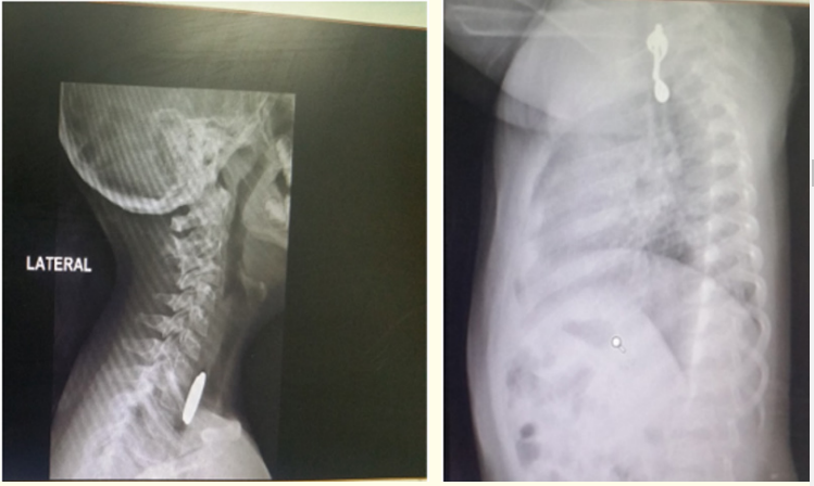 Figure 7: Step sign on lateral view (battery) and a
complex foreign body (ear ring).