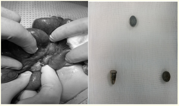 Figure 8: Magnet induced jejunal perforation.
