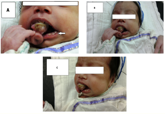 Figure 1 A-C: A well-defined mass protruding from the oral cavity
without adhesion to the oral vestibule, obliterating the buccal
vestibule with loose teeth in the lower front region of the jaw
(arrowed).