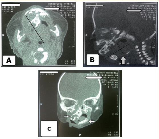 Figure 2 A-C: Native CT Images revealed A, oropharyngeal soft
tissue tumor with fat density extended from the upper oral cavity,
attached to the hard palate, more on the right side, the bone intact
with no erosion, the pharynx and larynx with normal boundaries.
B and C, opacification of the right sinuses by the fluid density
with opacification of 3-4 teeth in the lower front region of the
jaw (arrowed). The nasal septum deviated to the right (arrowed)
with non-patent right osteo meatal complex with no intracranial
extension.