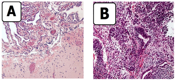 Figure 3 A,B: Histopathologic images revealed A, a mass
composed of mature glial tissue, a wide range of cellular
differentiation, a disorganized combination of mature adipose
tissue, mucin secreting glands, tooth structure, skin adnexes,
skeletal muscle, and bone. B, no immature component was
present. There was no evidence of malignancy. 