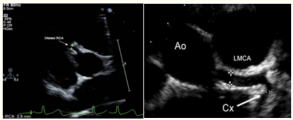 Figure 1: Short axis view showed in the left: dilated right
 coronary artery, in the right: dilated left coronary artery.