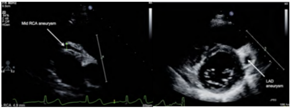 Figure 2: Short axis view showed in the left: right coronary
artery aneurysm, in the Right: left coronary artery aneurysm.