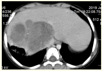 Figure 1: Abdomen CT scan shows the tumor and its
relationships with the VCI. 