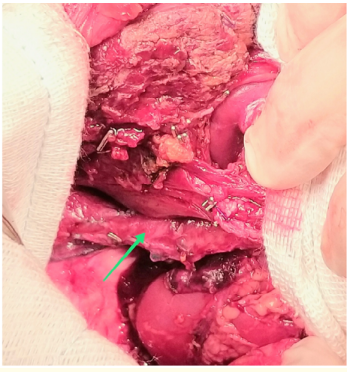 Figure 2: Intraoperative view demonstrates the remnant liver
 and VCI (the arrow) after right hepatectomy.