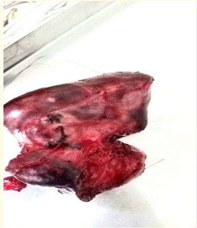 Figure 3: The specimen (right liver lobe).