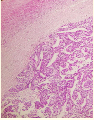 Figure 4: Micrograph showing a hepatoblastoma
(right of image) and normal liver (left of image).