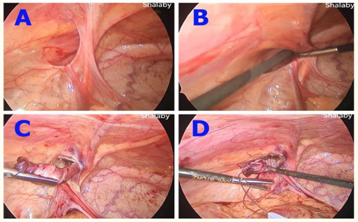 Figure 2: Steps of inversion and insertion of the snare. <br>
A. Left inguinal hernia in a girl. <br>
B. The ipsilateral Grasper is inserted into the hernia
 sac to grasp its fundus. <br> 
C. Inversion and twisting the hernia sac. <br>
D. The Grasper is passing into the opened snare loop.  