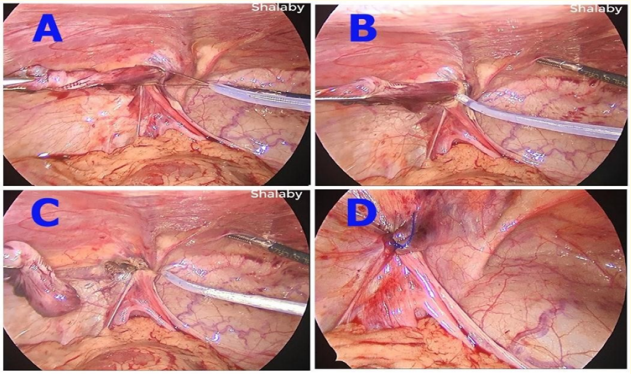Figure 3: Steps of snaring and suturing of small peritoneal
 defect. <br> 
A. Opened loop of the Snare is encircling the twisted invert
ed sac snugly and precisely <br> 
B. Closed loop of Snare around the twisted inverted with
 generation of a low current cutting mode diathermy and
proceeding carefully with short buzzes <br> 
C. Complete division of the sac with narrow raw area at its
neck without much diathermy to the surrounding sutures <br>
D. Closure of the narrow raw area of peritoneal defect  