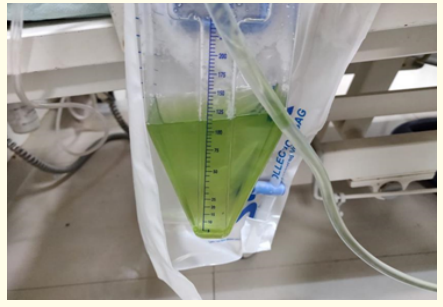 Figure 2: Urine turned green after treatment IV Methylene blue.