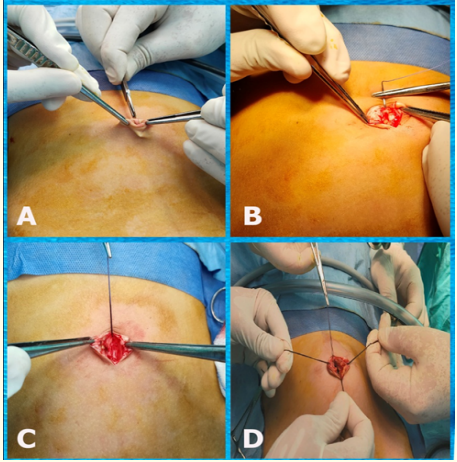 Figure 2: Steps of longitudinal umbilical incision and insertion of
4 stay sutures for traction and easy insertion of glove single port.