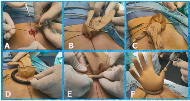 Figure 3: Insertion of home-made glove single port through
umbilical incision.
(A) Passing the inner ring through the umbilical incision aided by
traction sutures. (B) Insertion completed (C) Insertion and fixation
of the reusable working port. (D) Application of rigid outer ring. (E)
Rolling of the glove over the outer ring. (F) The glove single port
with complete fixation to the abdominal wall through the inner
and outer ring and inflation of abdomen.