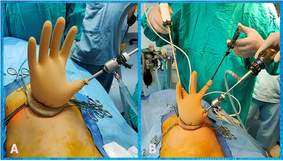 Figure 4: (A) Camera port was introduced through the thumb
finger of the glove with pneumoperitoneum. (B) Position of the
surgeon, camera man and the working instruments.