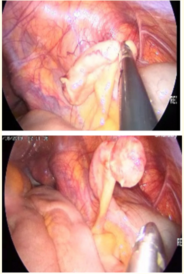 Figure 5: Intraoperative view of acute appendicitis.