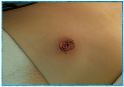 Figure 6: Immediate post- operative photo of umbilical wound.