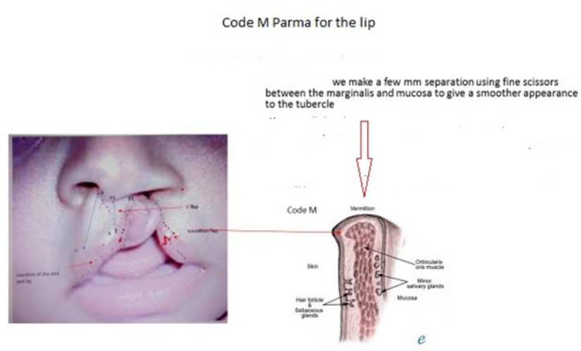 Figure 2: Code M Parma for the lip (courtesy Bergonzani M, Parma).