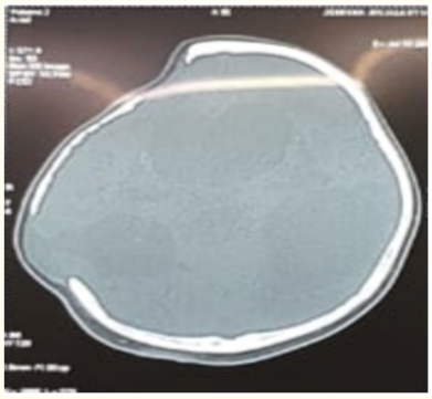 Figure 1: Computerised tomography imaging suggestive of
re-growth of bone at the craniectomy site defect.