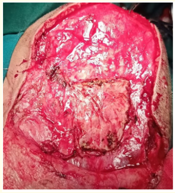 Figure 2: Operative image showing bone formation during
surgery.