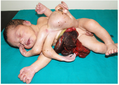 Figure 1: Showing heteropagus twins with attachment at the
epigastric and lower thorax. The parasitic component consists of a
pair of upper limbs and pelvis with lower extremities.