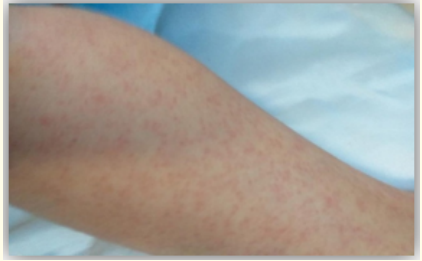 Figure 1: Skin rash.