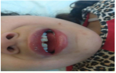 Figure 2: Strawberry tongue with cracked lips.