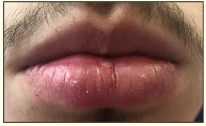 Figure 1: Right lower lip edema.