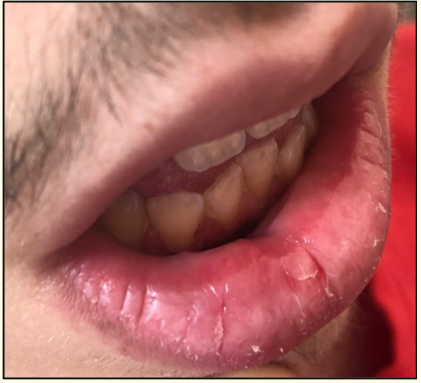 Figure 2: Violet and erythematous lesion in
the right lower lip mucosa.