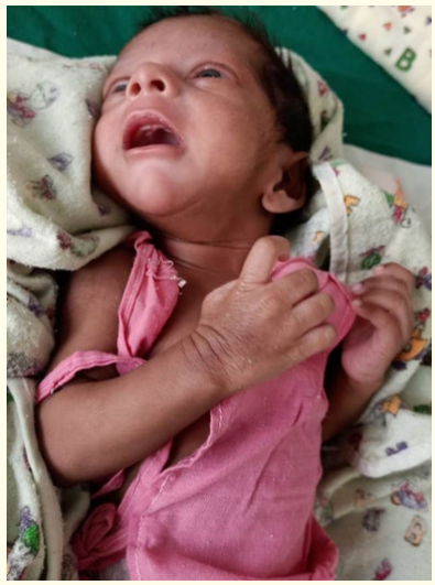 Figure 1: Neonate with ohtahara syndrome.
