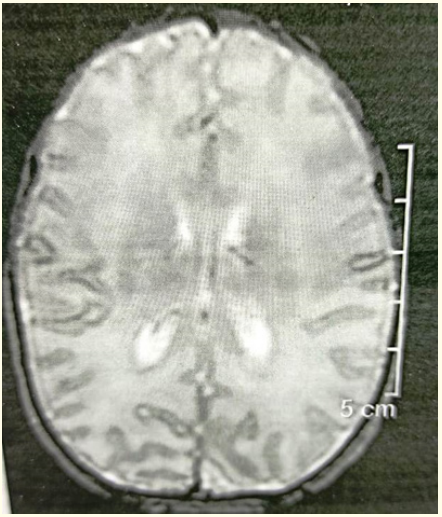 Figure 2: MRI brain of the patient.