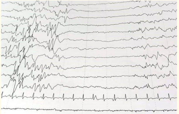 Figure 3: EEG of the neonate showing suppression burst pattern.
