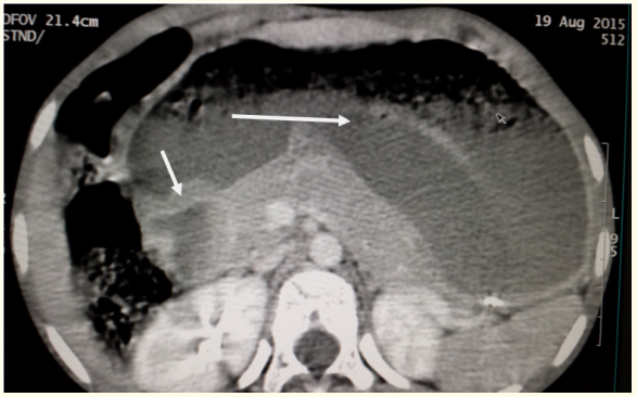 Figure 3: CT scan of the abdomen of this patient
showing a rim pancreatic tissue surrounding the second part of
the duodenum(small arrow) and fluid distended stomach
(long arrow).