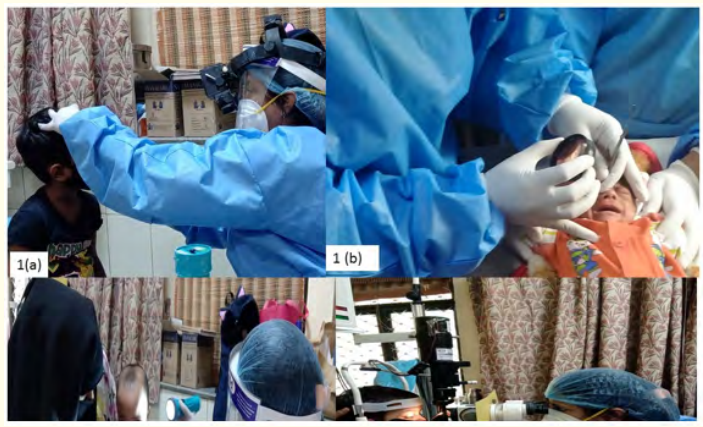 Figure 1: Ophthalmic examination by an ophthalmologist wearing gloves, mask face shield, disposable gown doing. 1a: Indirect ophthalmoscopy in a child. 1b: ROP screening in a preterm baby (aerosol generating is likely as the child is crying. 1c: Torch light examination in a child less than 2 years without mask. 1d: Slit lamp examination in a child with a protective shield in form of Xray film mounted at slit lamp.