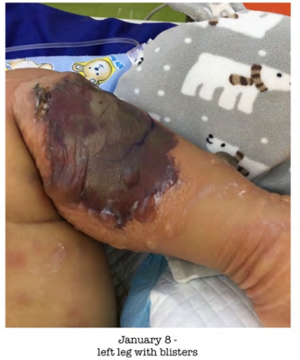 Figure 1: Left lower limb with skin lesions which clinically
correlate with of ecthyma gangrenosum.