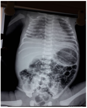 Figure 2: X-ray suggestive of distended bowel loops with no air
fluid levels. 