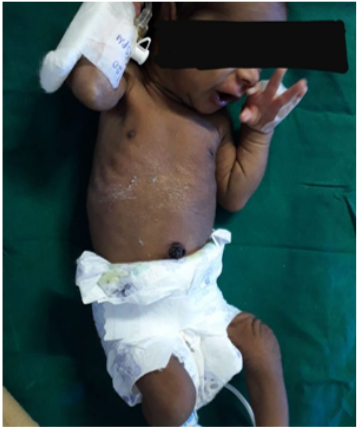 Figure 4: Post procedure - active baby, abdominal distension
subsided.
