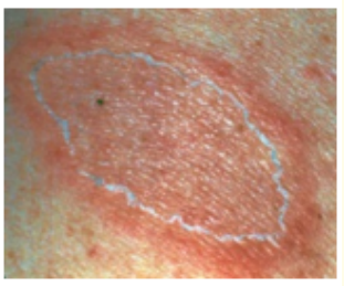 Figure 1: Pityriasis rosea depicting a classic herald patch surrounded by fine, pink scales [9].