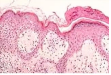 Figure 2: Pityriasis rosea delineating mild parakeratosis, spongiosis, hyperkeratosis, epidermal hyperplasia and a superficial
inflammatory exudate of lymphocytes and histiocytes [10].