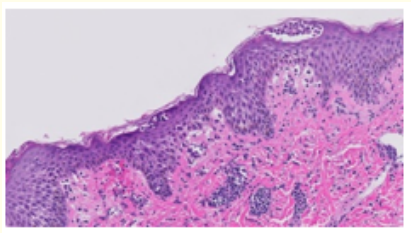 Figure 3: Pityriasis rosea demonstrating mild acanthosis,
hyperkeratosis, parakeratosis, spongiosis and an upper dermal infiltrate of lymphocytes and macrophages along with few vascular
articulations [11]. 