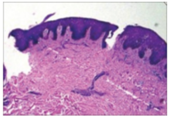 Figure 4: Pityriasis rosea exhibiting acanthosis, hyperkeratosis,
parakeratosis and spongiosis along with superficial dermal inflammatory infiltrate of lymphocytes and histiocytes [12].