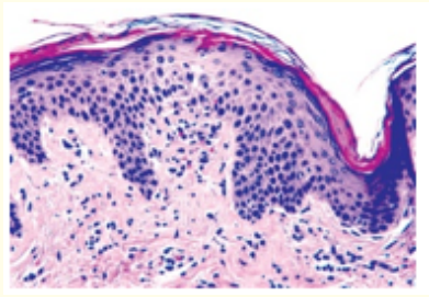 Figure 5: Pityriasis rosea enunciating acanthosis, parakeratosis,
hyperkeratosis, epidermal hyperplasia, mild spongiosis and an
inflammatory exudate of lymphocytes and histiocytes confined to
the dermis [13]. 