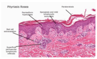 Figure 6: Pityriasis rosea displaying mild spongiosis, epidermal
hyperplasia, hyperkeratosis, an upper dermal chronic inflammatory infiltrate and several vascular articulations [14].
